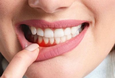 Vitamin Eksikliğinin Ağızdaki Belirtileri: Tanı ve Tedavi Yöntemleri