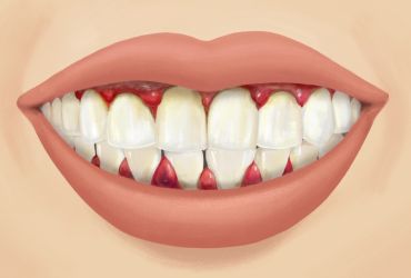 Skorbüt Hastalığı Nedir? Belirtileri ve Tedavi Yöntemleri