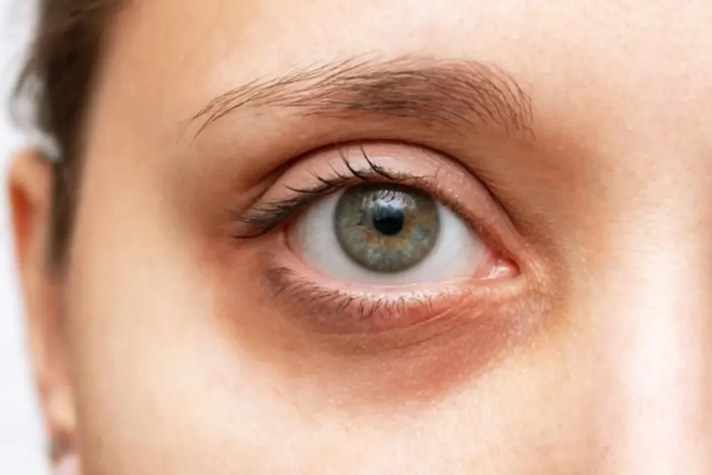 Göz Altı Morluklarına Hangi Vitamin Eksikliği Neden Olur?