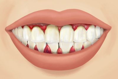 Skorbüt Hastalığı Nedir? Belirtileri ve Tedavi Yöntemleri