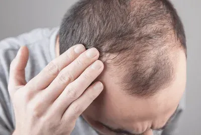 Saç Dökülmesi Hangi Vitamin Eksikliğinde Olur? Nasıl Giderilir?